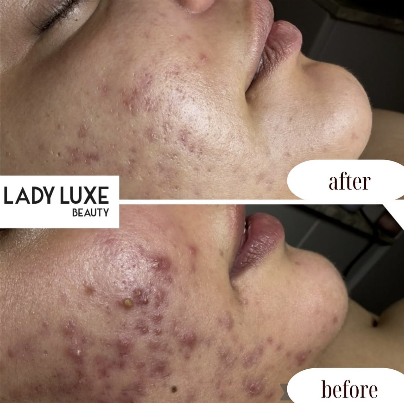 Acne before and after