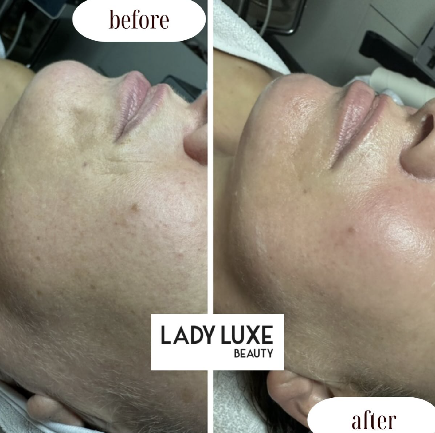 Pigmentation before and after
