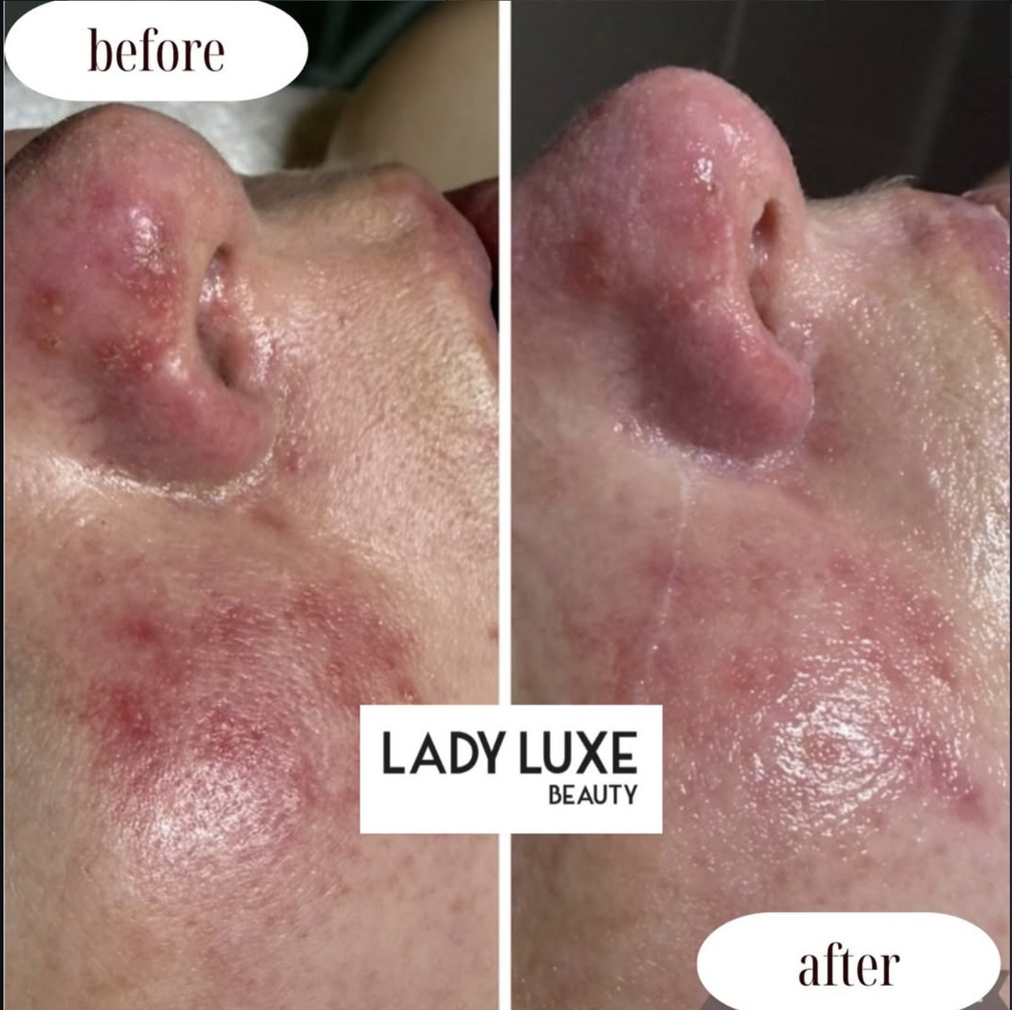 Inflamed Skin before and after